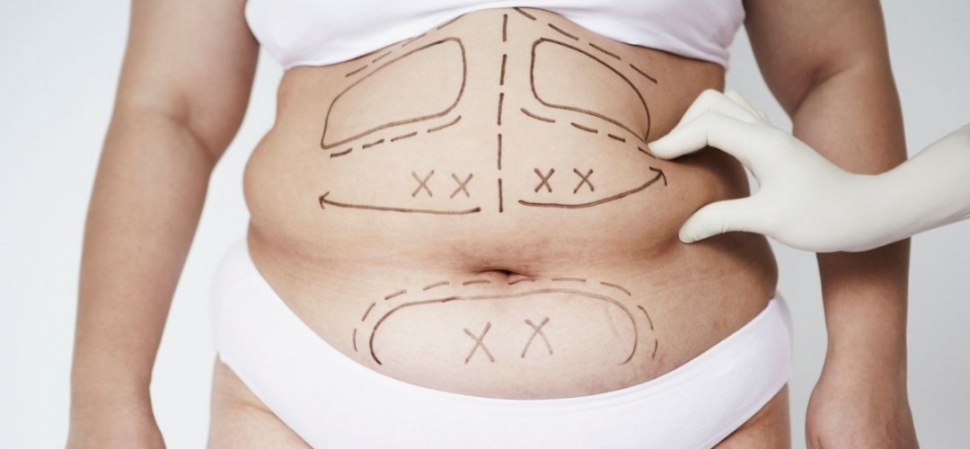Was İst Ein Mommy Makeover (Mami-Verjüngung)? Was İst Ein Mommy Makeover (Mami-Verjüngung)?
