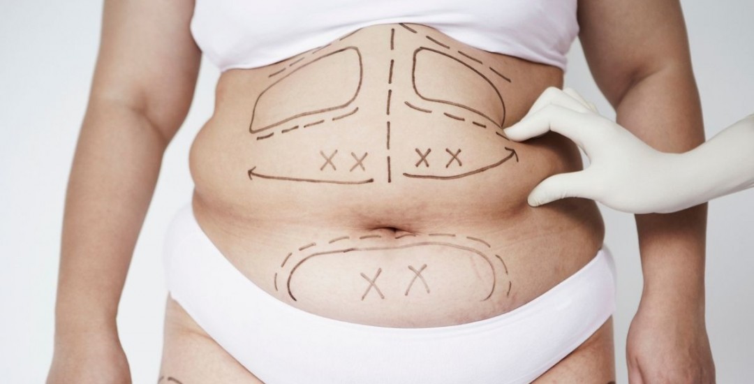 Annelik Estetiği (Mommy Makeover) Nedir?