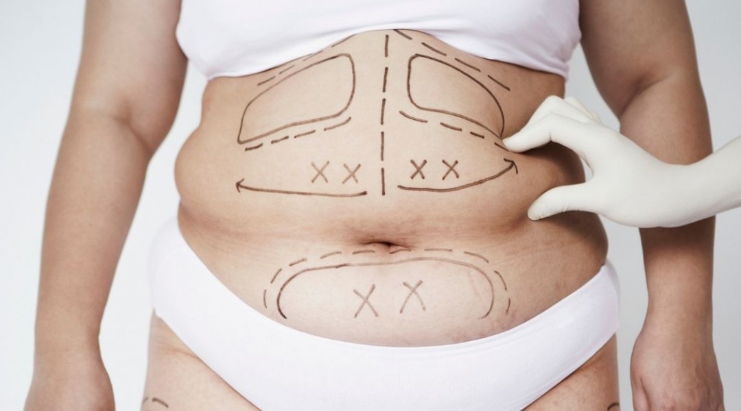 Was İst Ein Mommy Makeover (Mami-Verjüngung)?