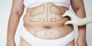 Was İst Ein Mommy Makeover (Mami-Verjüngung)?