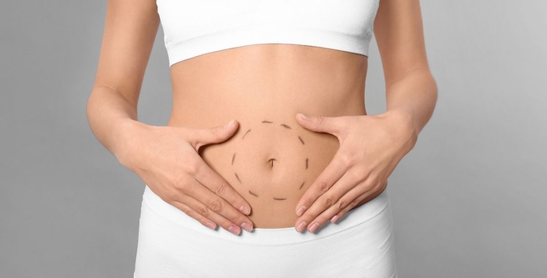 İstanbul Karın Germe Ameliyatı