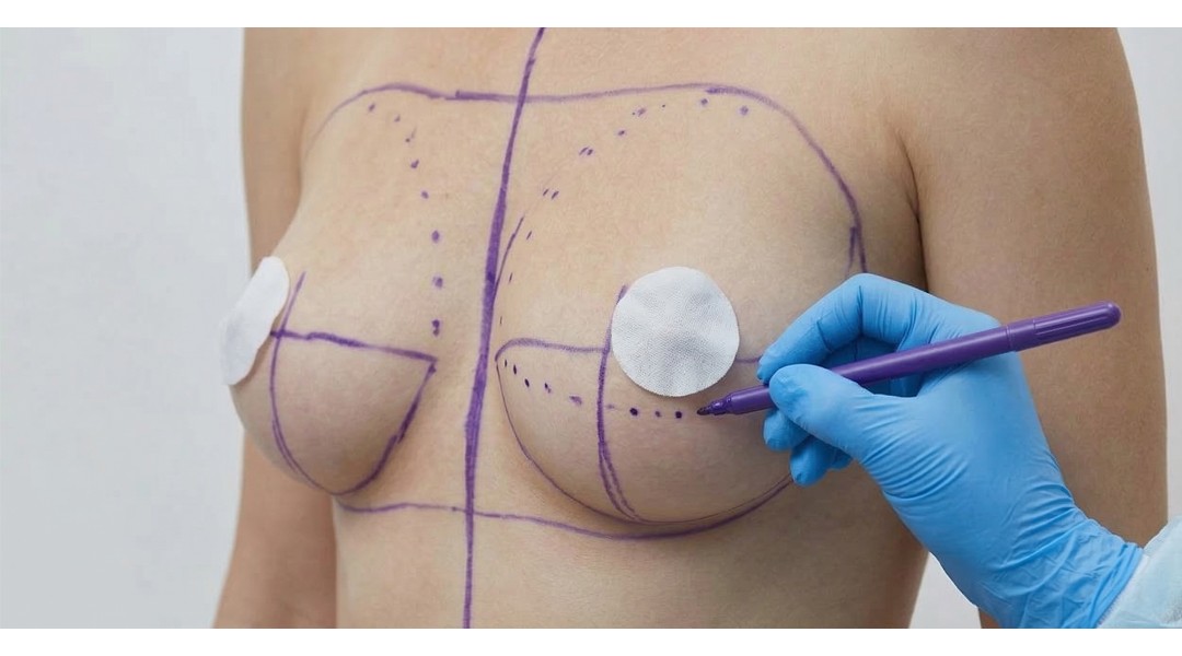 Breast Lift or Breast Augmentation? Which One Should Be Preferred in Which Situation?