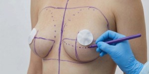 Подтяжка груди или увеличение груди? В каких случаях какой метод предпочтительнее?