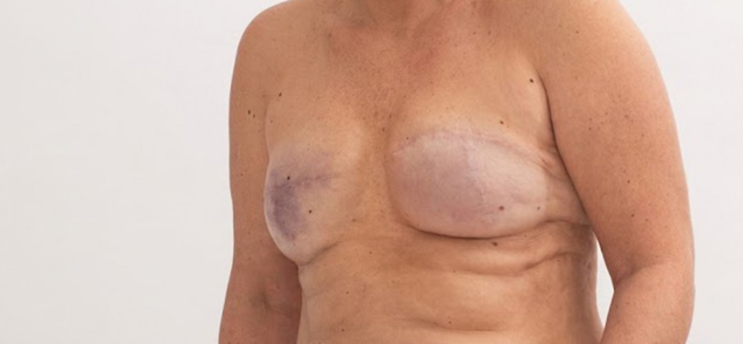 Breast Reconstruction: Rebuilding After Breast Cancer