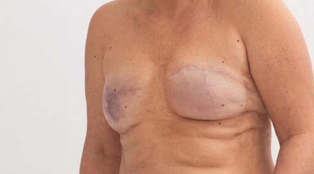 Breast Reconstruction: Rebuilding After Breast Cancer