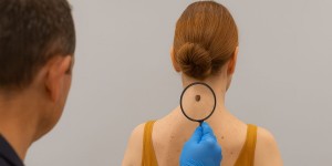 Gefährliche Muttermale: Symptome Und Früherkennung Von Melanomen