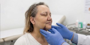 How Long Does Swelling And Bruising Last After A Facelift Surgery?