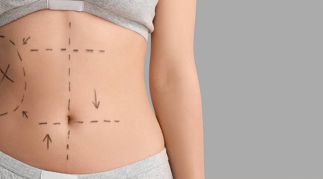 Liposuction