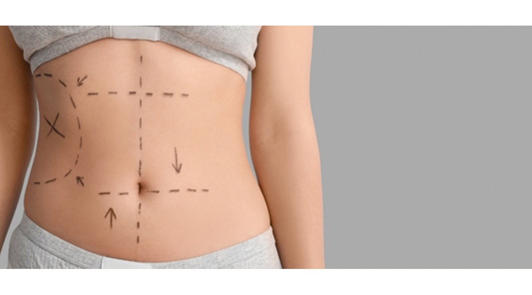 Liposuction