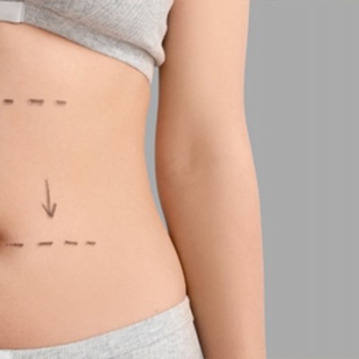 Liposuction (Yağ Alma)