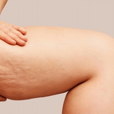 Uyluk Germe Ameliyatı