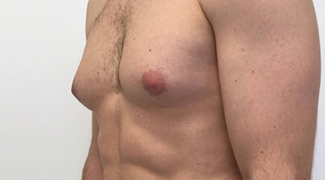 Gynecomastia Surgery