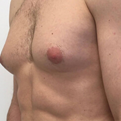 Jinekomasti Ameliyatı