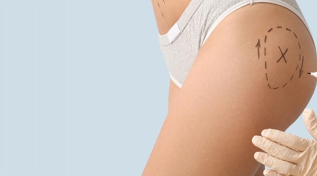 Buttock Contouring Aesthetics