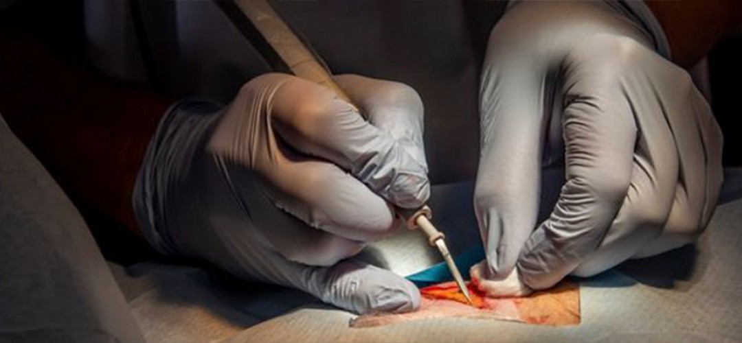 Cancer Surgery