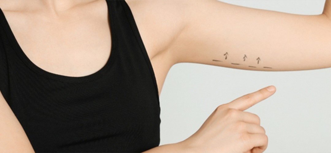 Arm Lift Surgery