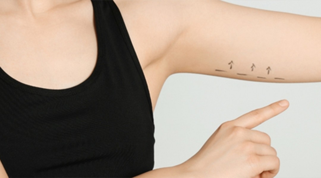 Arm Lift Surgery
