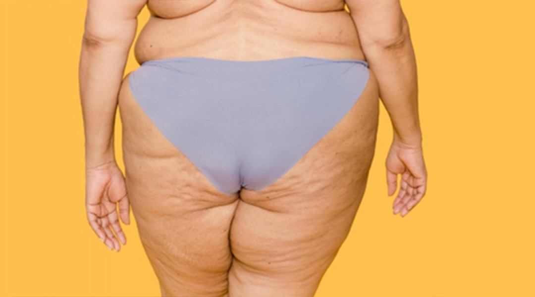 Lipedema Treatment