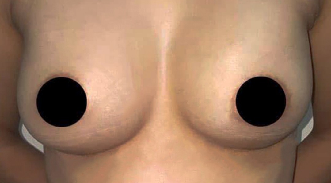 Breast Augmentation Surgery