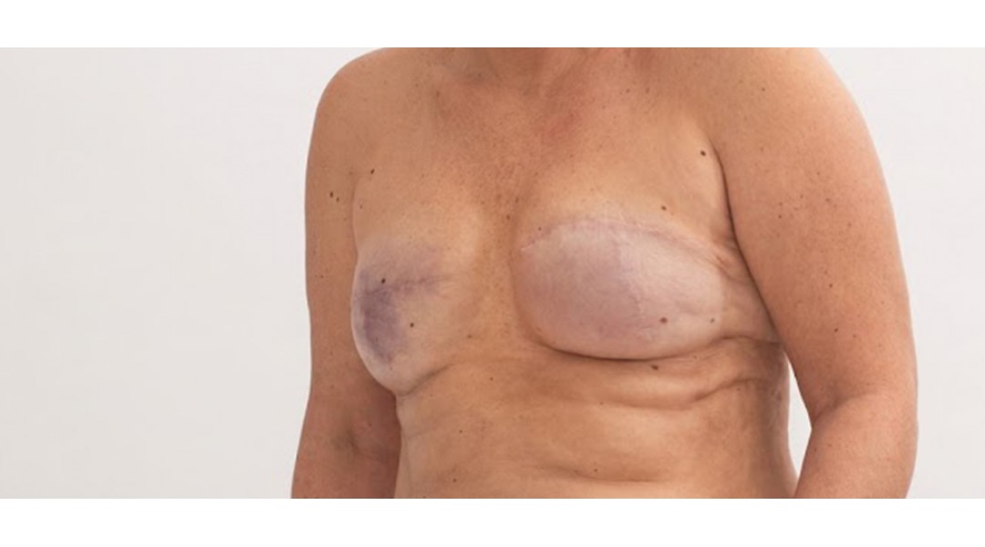 Breast Reconstruction Surgery