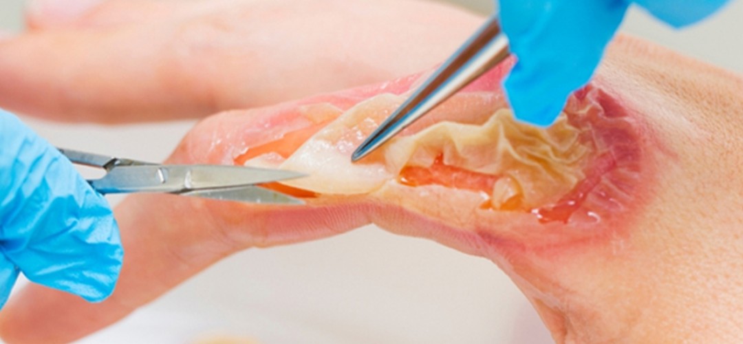 Burn and Wound Treatments
