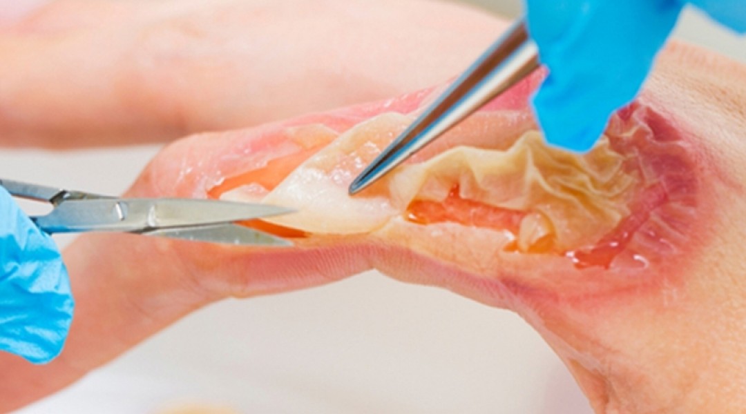 Yanık ve Yara Tedavileri