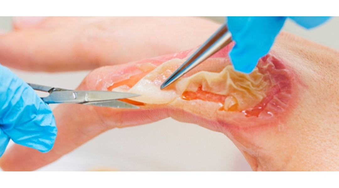 Burn and Wound Treatments