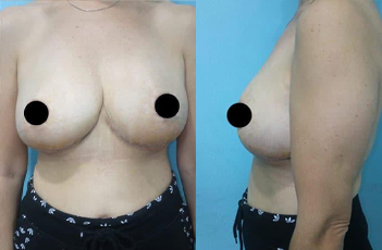 Do breast reduction scars remain?
