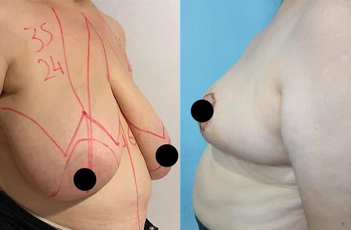 How is breast reduction performed?